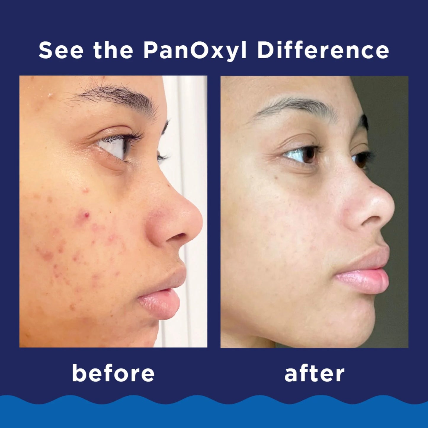 PanOxyl Foaming Acne Wash, 10% Benzoyl Peroxide, Maximum Strength - 5.5 oz